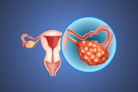 Can PCOD Affect Fertility? Connection Explained — by Dr. Deepa Seth