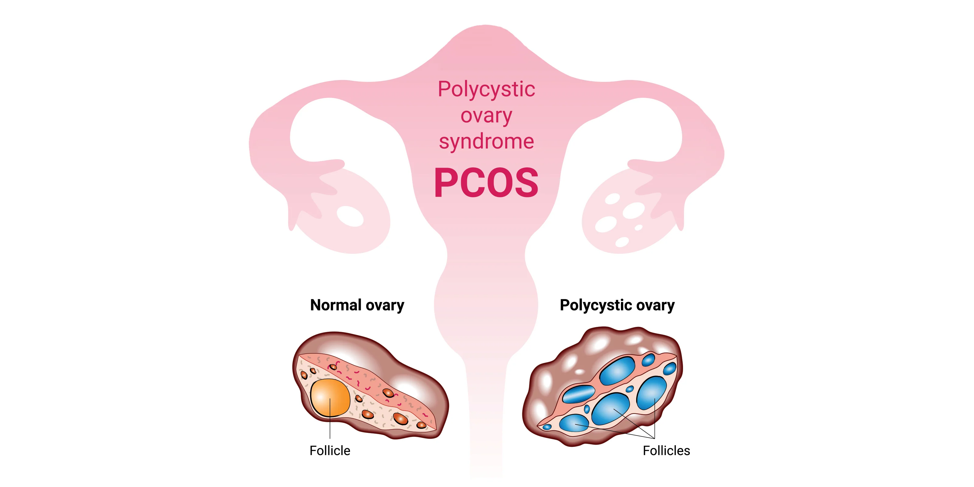 PCOD in Women — Causes, Symptoms & Treatment | Dr. Deepa Seth